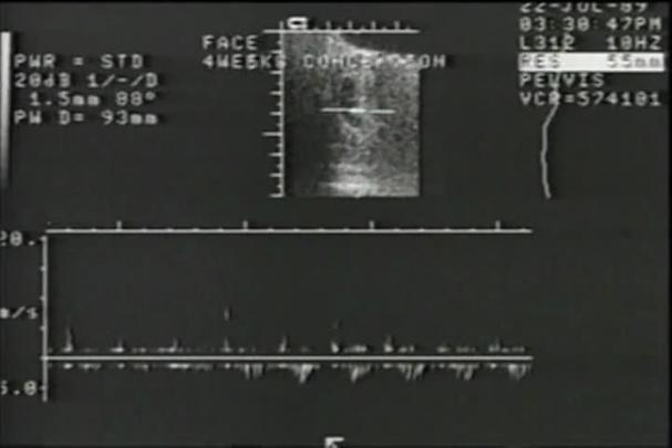 Thumbnail image for Love Them Both - Tribute To Marla Cardamone Who Died In Abortion